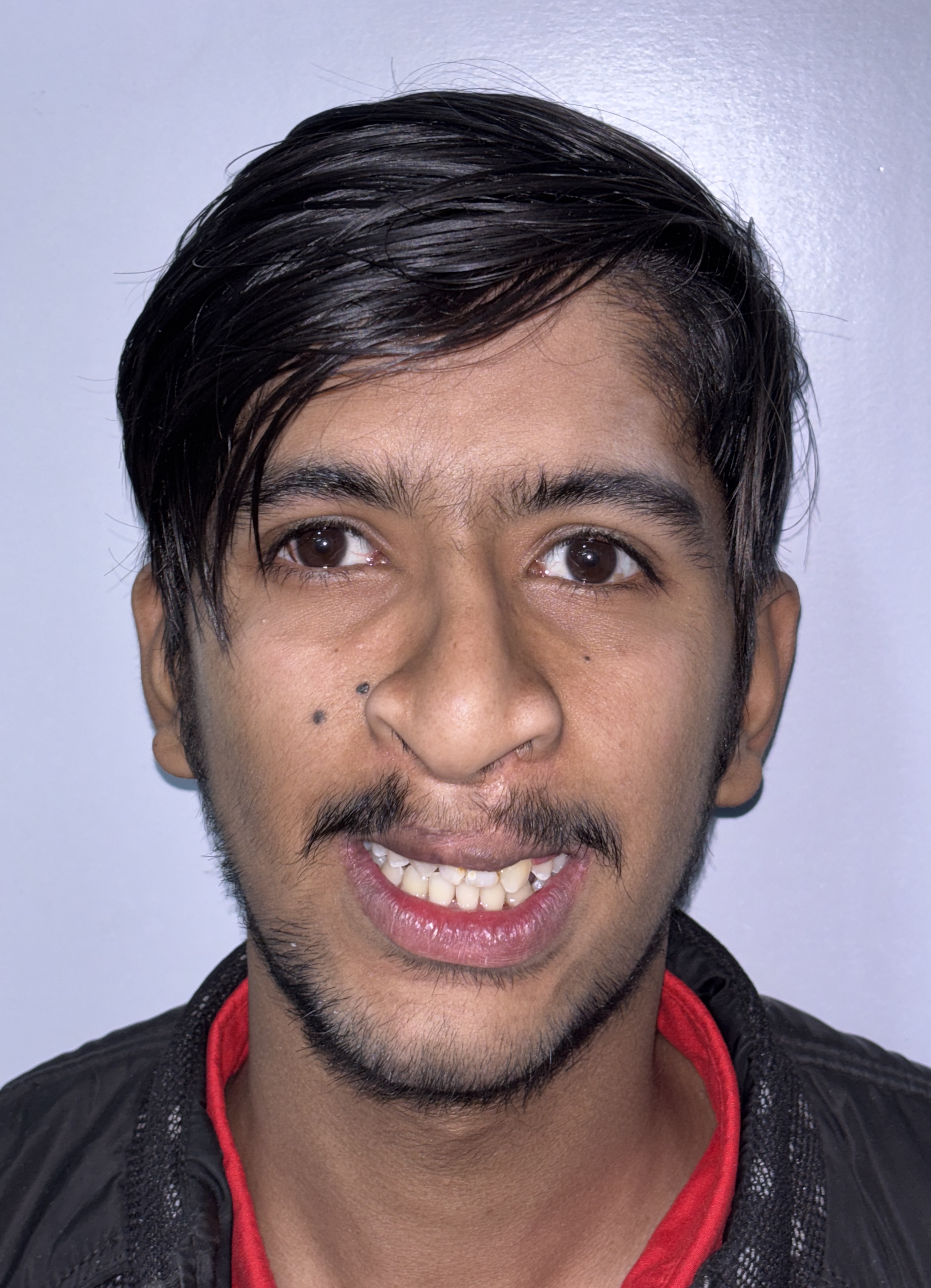 Severe Maxillary Retrusion Corrected - After Combined Orthodontic & Surgical Management
